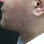 Male Facial Aesthetic Surgery Before & After Patient #8822