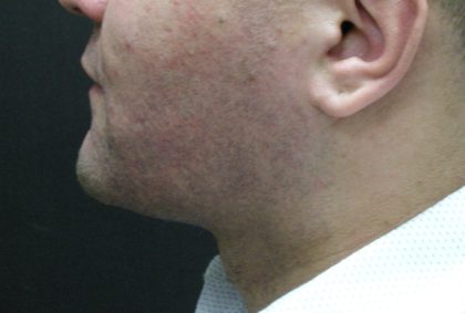 Male Facial Aesthetic Surgery Before & After Patient #8822