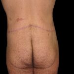 Male Body Contouring Before & After Patient #8851
