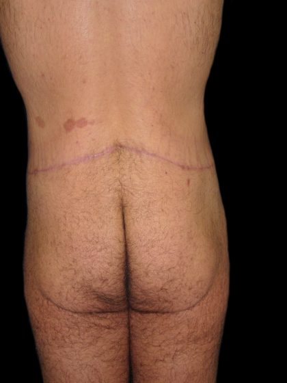 Male Body Contouring Before & After Patient #8851