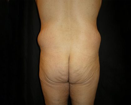 Male Body Contouring Before & After Patient #8849