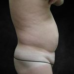 Male Body Contouring Before & After Patient #8850