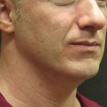 Male Facial Aesthetic Surgery Before & After Patient #8823