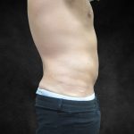 Male Body Contouring Before & After Patient #8852