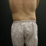 Male Body Contouring Before & After Patient #8849