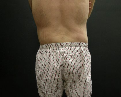 Male Body Contouring Before & After Patient #8849