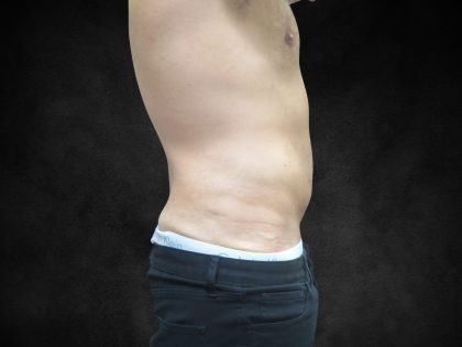 Male Body Contouring Before & After Patient #8852