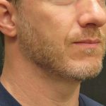 Male Facial Aesthetic Surgery Before & After Patient #8823