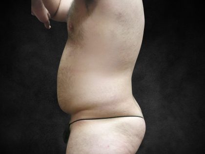 Male Body Contouring Before & After Patient #8852