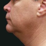 Male Facial Aesthetic Surgery Before & After Patient #8820