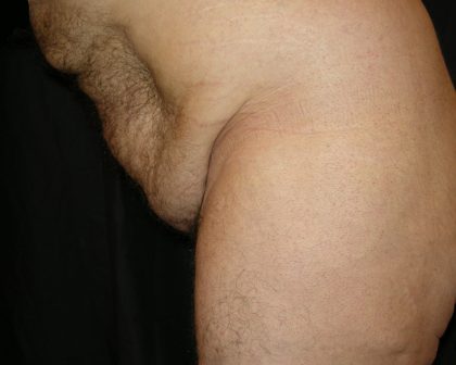Male Body Contouring Before & After Patient #8849