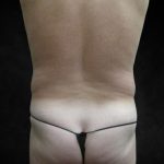 Male Body Contouring Before & After Patient #8850