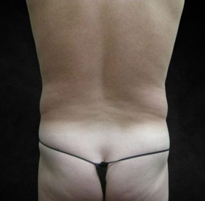 Male Body Contouring Before & After Patient #8850