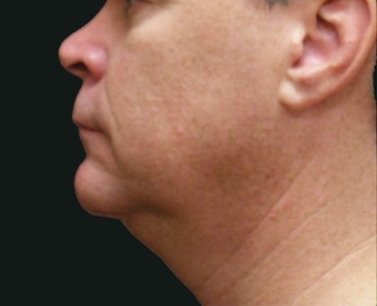 Male Facial Aesthetic Surgery Before & After Patient #8820