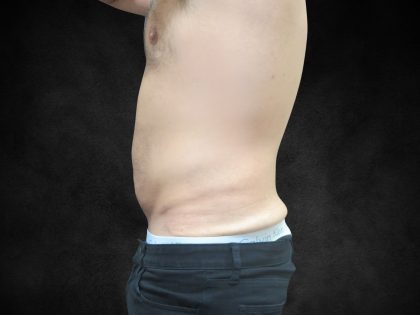 Male Body Contouring Before & After Patient #8852