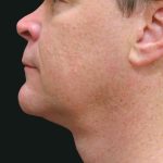 Male Facial Aesthetic Surgery Before & After Patient #8820