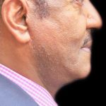 Male Facial Aesthetic Surgery Before & After Patient #8821