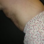 Male Body Contouring Before & After Patient #8849
