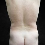 Male Body Contouring Before & After Patient #8850