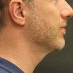Male Facial Aesthetic Surgery Before & After Patient #8823