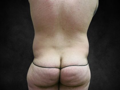 Male Body Contouring Before & After Patient #8852