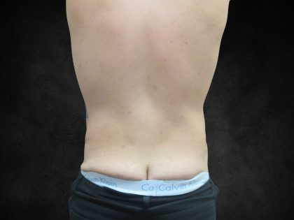 Male Body Contouring Before & After Patient #8852