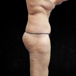Post Weight Loss Before & After Patient #9218