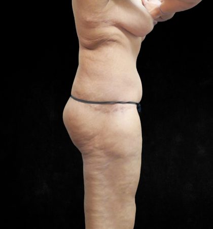 Post Weight Loss Before & After Patient #9218