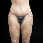 Post Weight Loss Before & After Patient #9218