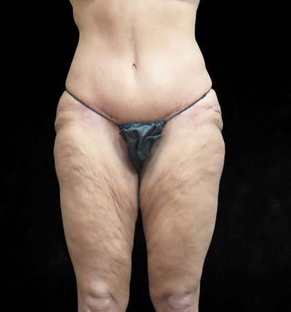 Post Weight Loss Before & After Patient #9218