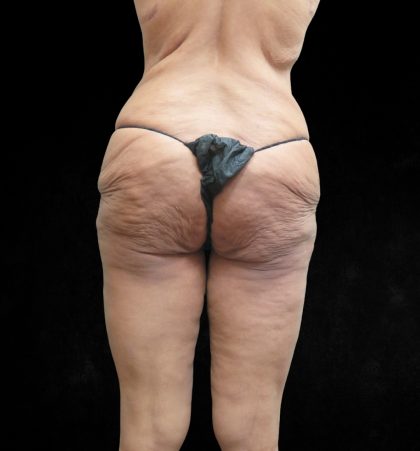 Post Weight Loss Before & After Patient #9218