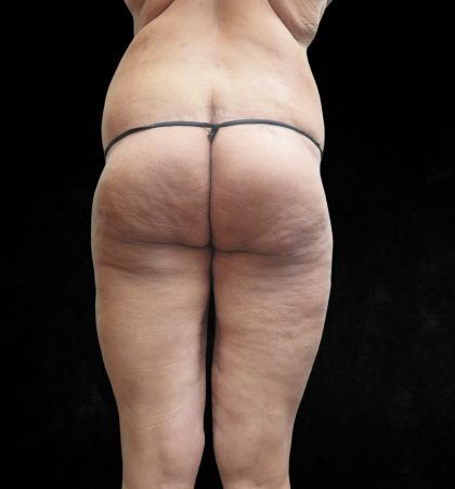 Post Weight Loss Before & After Patient #9218