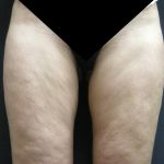 Cellulite Treatment Before & After Patient #10861