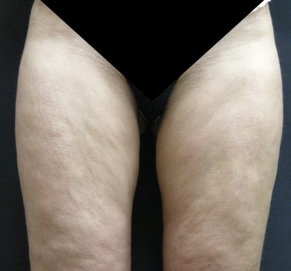 Cellulite Treatment Before & After Patient #10861