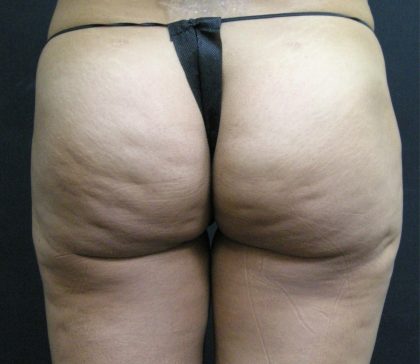 Cellulite Treatment Before & After Patient #10862
