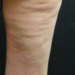 Cellulite Treatment Before & After Patient #10863