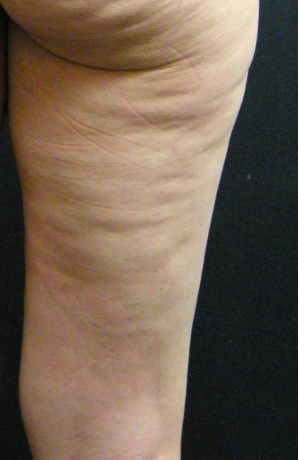 Cellulite Treatment Before & After Patient #10863