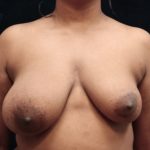 Breast Asymmetry Before & After Patient #10901
