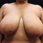 Breast Asymmetry Before & After Patient #10903