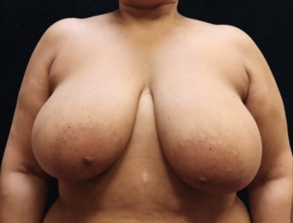 Breast Asymmetry Before & After Patient #10903