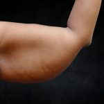 Arm Lift Before & After Patient #10814