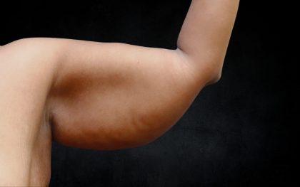 Arm Lift Before & After Patient #10814