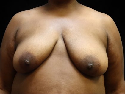 Breast Lift Before & After Patient #11049