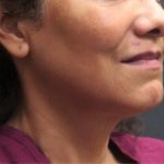 Scarless Facelift and Necklift Before & After Patient #11100