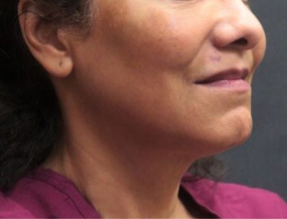 Scarless Facelift and Necklift Before & After Patient #11100
