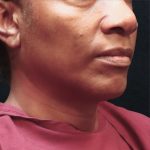 Scarless Facelift and Necklift Before & After Patient #11101