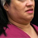 Scarless Facelift and Necklift Before & After Patient #11102