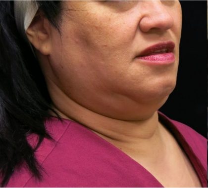 Scarless Facelift and Necklift Before & After Patient #11102