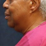 Scarless Facelift and Necklift Before & After Patient #11103
