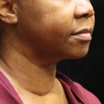 Scarless Facelift and Necklift Before & After Patient #11104